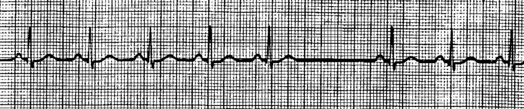 SINUS BLOCK RATE: < 100 bpm RHYTHM: Irregular P-R INTERVAL: < 0.20 seconds QRS WIDTH: < 0.12 seconds P-QRS-T : P for every QRS MISSING/ADDED? : P-wave @ next expected location.