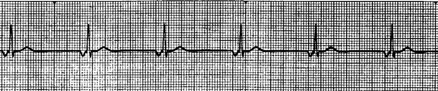 JUNCTIONAL RHYTHM RATE: 40-60 bpm RHYTHM: Regular QRS WIDTH: < 0.12 seconds P-QRS-T : P waves, if present, inverted. P-R INTERVAL : < 0.