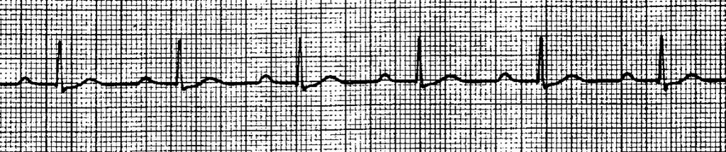 IDENTIFYING FEATURES : o Narrow complex QRS occurring before next expected QRS complex o P-wave, if present, inverted before the early QRS complex o Rate of 40-60 bpm.