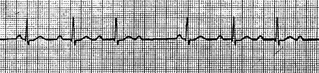 SECOND DEGREE AV HEART BLOCK Mobitz TYPE I WENCKEBACH RATE: < 100 bpm QRS WIDTH: < 0.