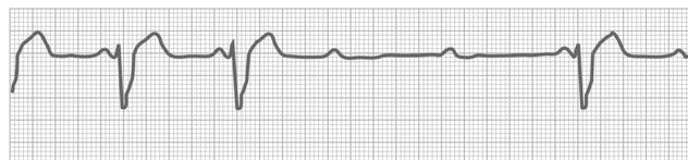 : QRS complexes IDENTIFYING FEATURES: o PR Interval increases until there is a dropped QRS complex after a P-wave. Mobitz Type II RATE: < 100 bpm QRS WIDTH: < 0.