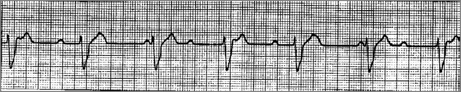 THIRD DEGREE AV HEART BLOCK RATE: < 60 bpm RHYTHM: Regular P-R INTERVAL : Variable QRS WIDTH: > 0.12 seconds P-QRS-T: No QRS for every P-wave MISSING/ADDED?
