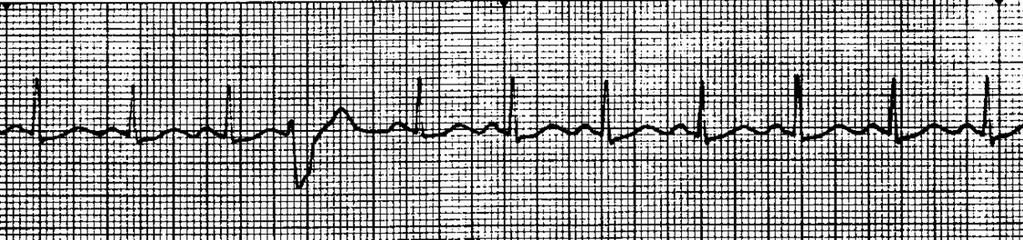 o No P-QRS marriage o Regular slow ventricular response o Atria & Ventricles are functioning totally INDEPENDENT of each other. PREMATURE VENTRICULAR COMPLEX: UNIFOCAL RATE: Underlying rhythm is.