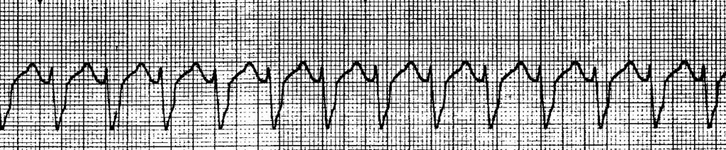 Cardiac Arrest Rhythms: This Section discusses the Rhythms you may see in a Cardiac Arrest Patient.