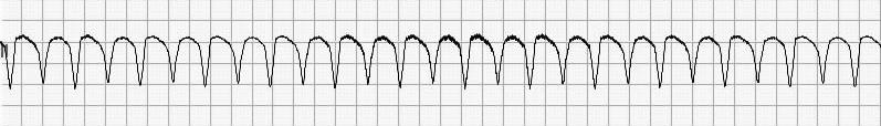 VENTRICULAR TACHYCARDIA RATE: > 100 bpm RHYTHM: Regular P-R INTERVAL : No P-waves QRS WIDTH: > 0.
