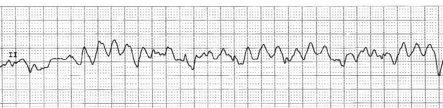 INTERVAL : No P-waves QRS WIDTH: > 0.