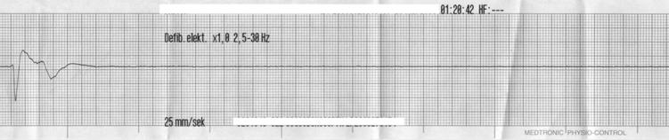 Pulseless Electrical Activity (PEA) One of the more important ECG tracings that you need to be able to recognize is Pulseless Electrical Activity, also known as PEA.