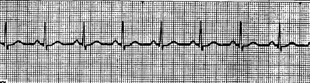 20 seconds ( 5) thus, 1 small square = 0.04 seconds Here is an example of a normal ECG tracing The PR Interval should be less than 0.20 seconds. This is 1 large square or 5 small squares The QRS complex should be less than 0.