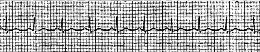 b. Regularly irregular c. Chaotic (VF) d. Artifact 3. P-R INTERVAL i. Normal = 0.12-0.20 seconds 4. P-QRS-T RELATION i.