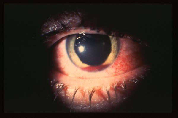 the cornea or limbus Blood
