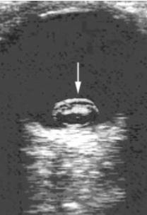 Ultrasound of the Eye Summary Perform a