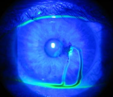 Decreased acuity - Localized corneal edema - Scleral