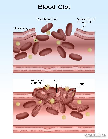 Formation of a Blood Clot: 1. Platelets travel along the bloodstream ensuring all is well. 2. Platelets chemically change in reaction to an injury. 3.