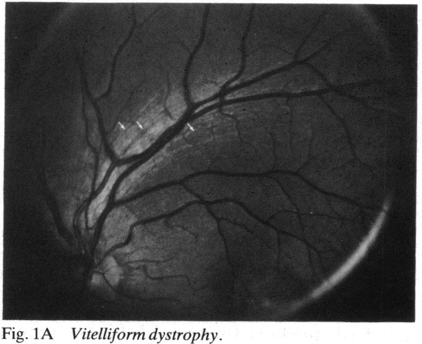 Fundus flavimaculatus 20/80 Normal Normal OU 8 44 Choroideraemia (carrier) 20/30 Borderline normal Normal OU 20/20 in the right eye and 20/50 in the left (Fig. 1A).