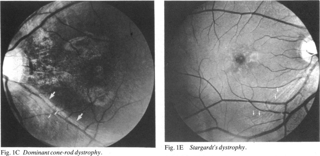 Nervefibre layer loss in diseases of the outer retinal layer Fig. IC Dominant cone-rod dystrophy. Fig. I L) Leber's congenitl amt urosis. scotopic ERGs were barely recordable.