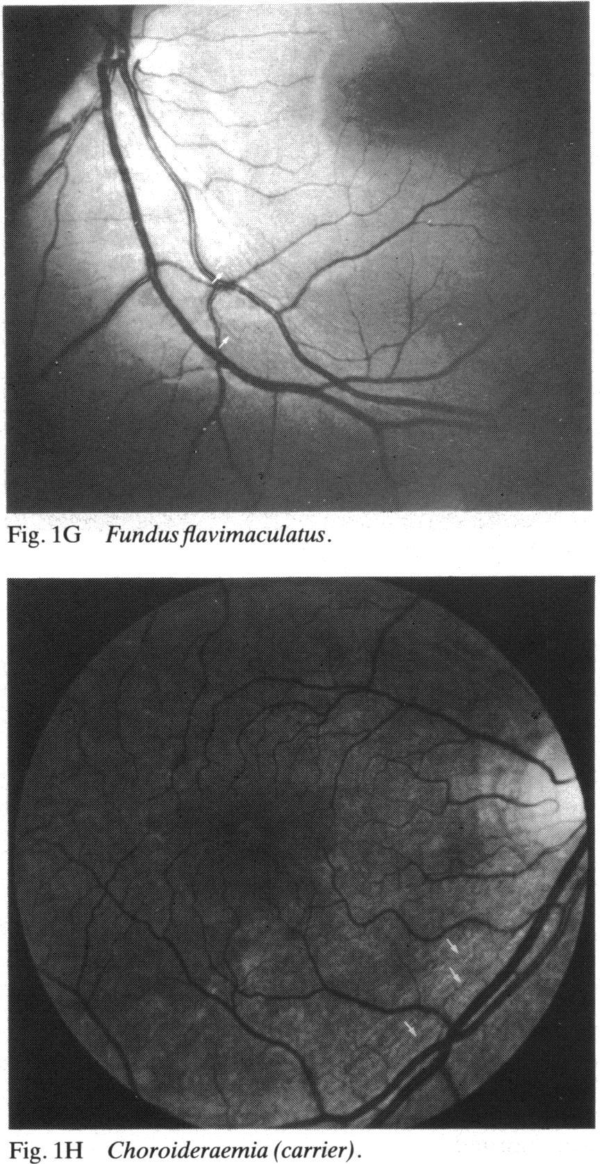 In previously reported cases of damage to the retinal nerve fibre layer the primary insult has been to the optic nerve or another portion of the ganglion cell axon, such as the chiasm.