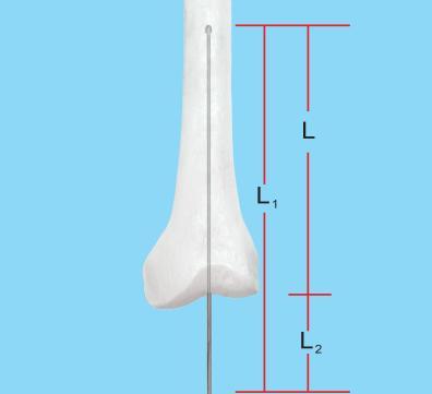 6. Confirm the nail length Measure the length of the exserted guide wire, L 2, and subtract it from the overall length L 1, then the required nail length L= L 1 - L 2.