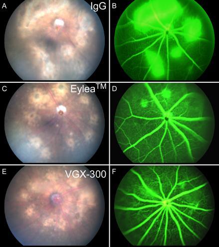 model of wet AMD. Plasma VEGF-A, VEGF-C and VEGF-D levels in subjects with AMD and controls were quantitated using multiplex assay (Biorad).