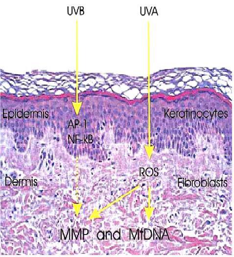Photoaging of human skin. When the epidermis of the skin absorbs the UVB radiation from the sunlight, it results in the induction of metalloproteinases (MMPs).
