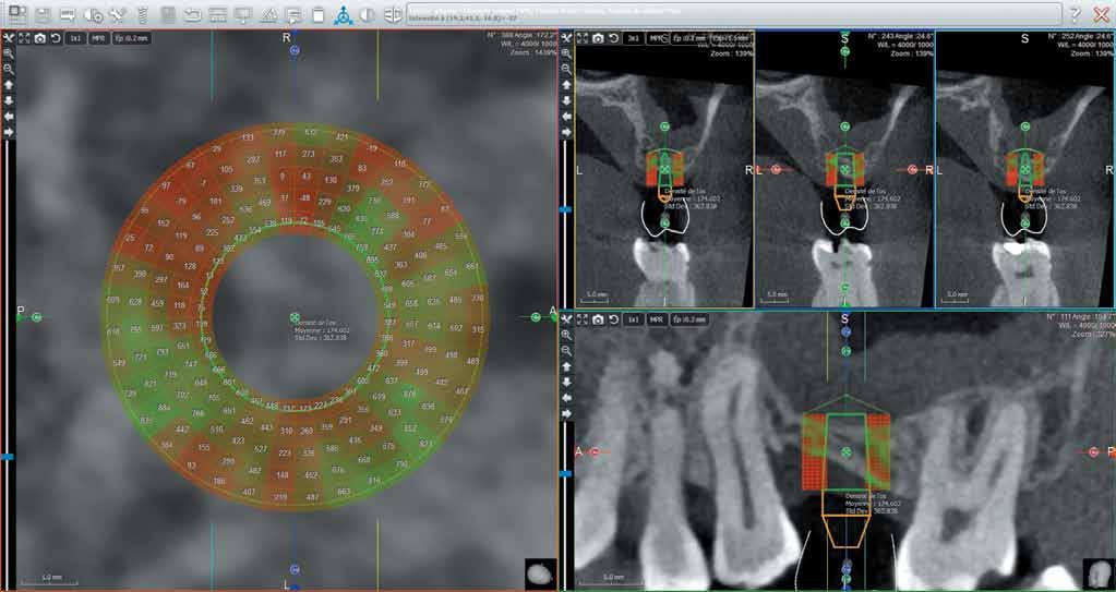 The ACTEON Imaging Suite 3D software displays the assessment of bone density all around the implant with just one click.