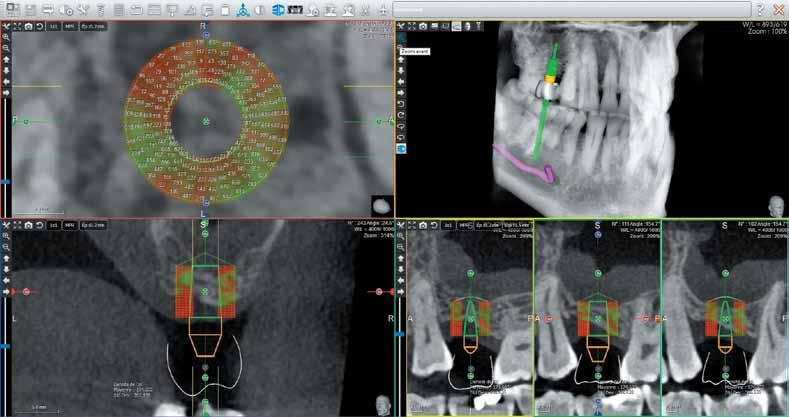 SIMPLIFIED IMPLANT PLANNING CARRY OUT 1 Locating and tracing the mandibular canal