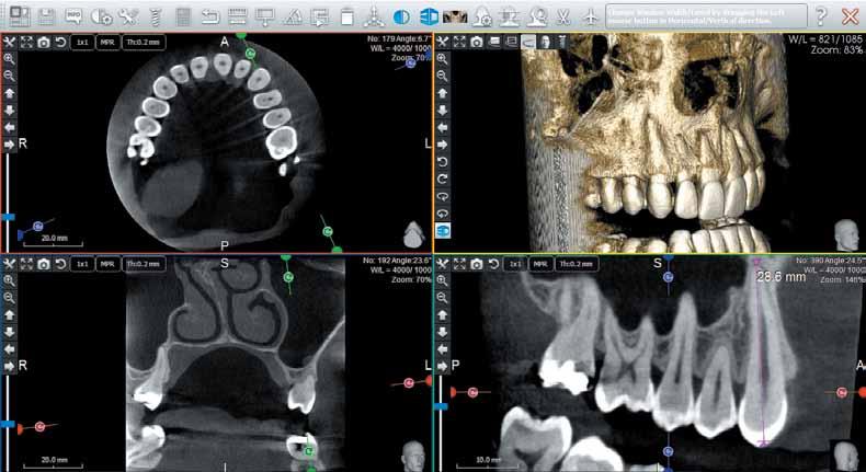 DETAILED IMAGING FOR ENDODONTICS A THREE-DIMENSIONAL IMAGE FOR A MORE ACCURATE DIAGNOSIS 5