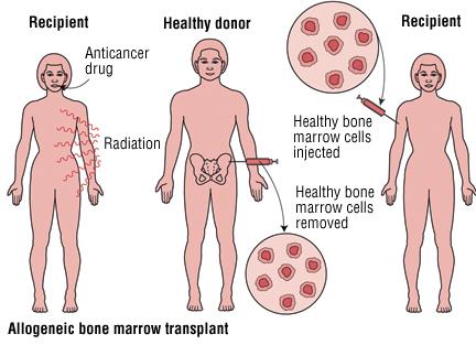 What is hematopoietic stem cell transplantion (HSCT)? HSCT is the procedure of infusing blood stem cells from a donor into a recipient.