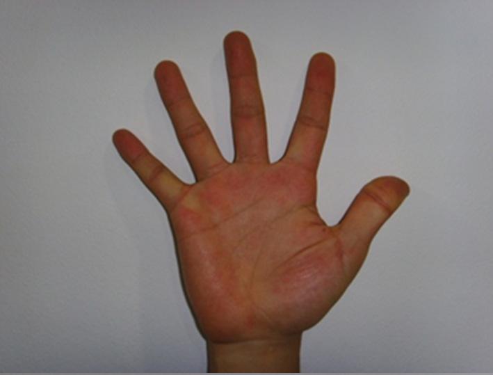 In fetuses, the difference in digit ratio between sexes is found as early as the end of the first trimester (Galis et al., 2010; Malas et al., 2006).
