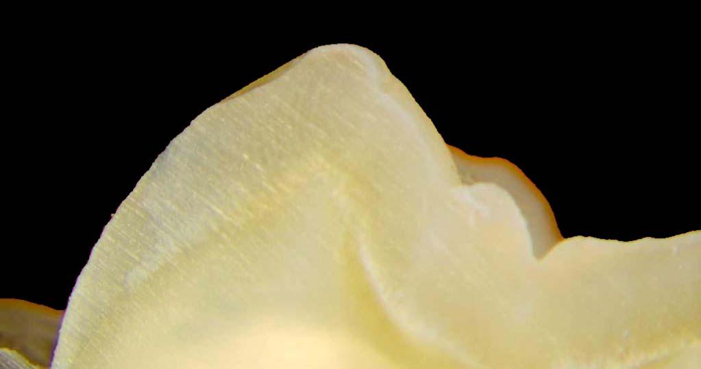 Lava All Zirconia Wear Test on Human Teeth
