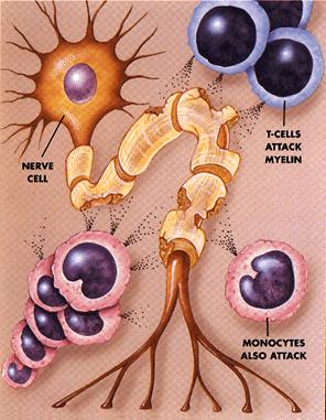Nervous System Disorders Multiple Sclerosis Description: Autoimmune disease that affects the central nervous system. Myelin is lost in multiple areas, leaving scar tissue called sclerosis.