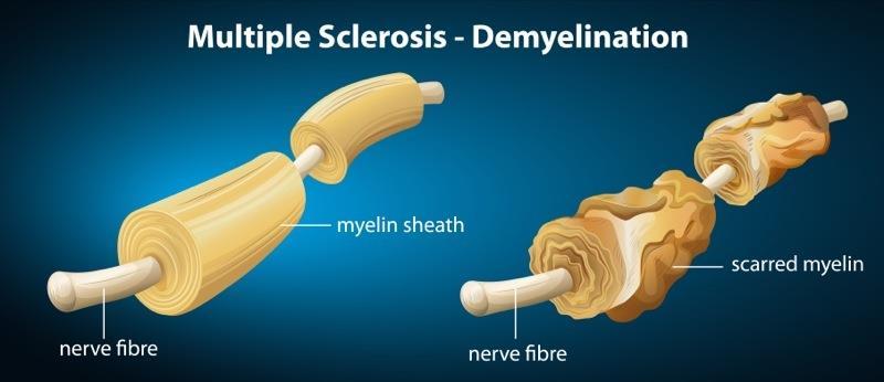 More About Myelin Multiple Sclerosis (MS) Autoimmune disease where the body attacks the