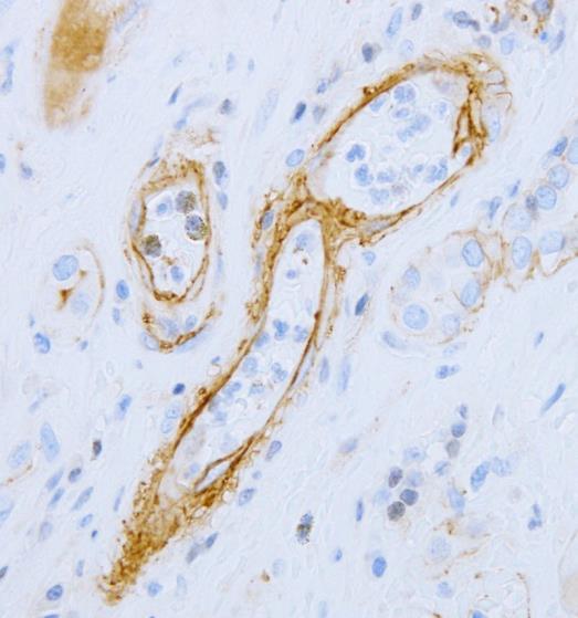 PMN Donor Specific Antibody C4d variable positive PTC