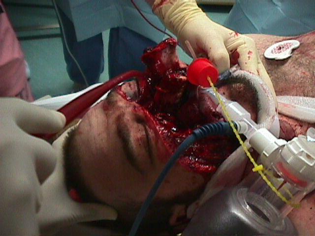 Compromise of the Airway in Trauma Patients I Direct airway