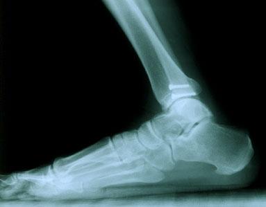 ankle pain?
