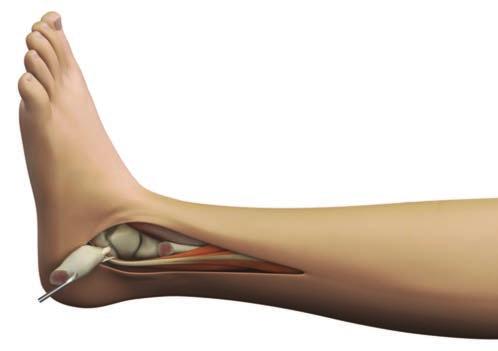 2 Section 2: Exposure and Sizing Reflect the distal fibular segment. Place a periosteal elevator in the lateral gutter to pry and dissect tissue.