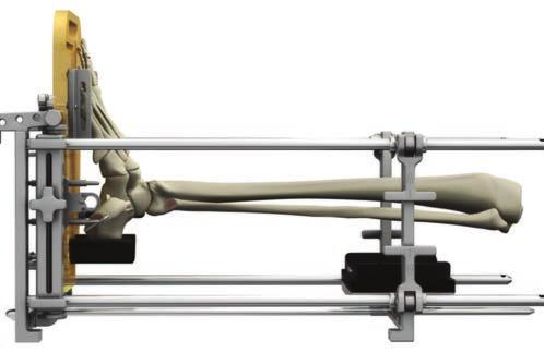 Then relock the lever fasteners (Fig. 22). Add or remove Calf Support Blocks so the tibial crest is parallel to the longitudinal Frame Rods (Fig. 23).