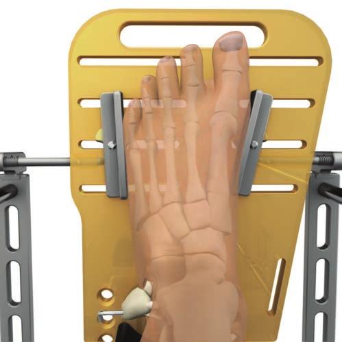 (Fig. 24). Be sure that the Foot Plate Brackets are attached at the appropriate slots in the Foot Plate.