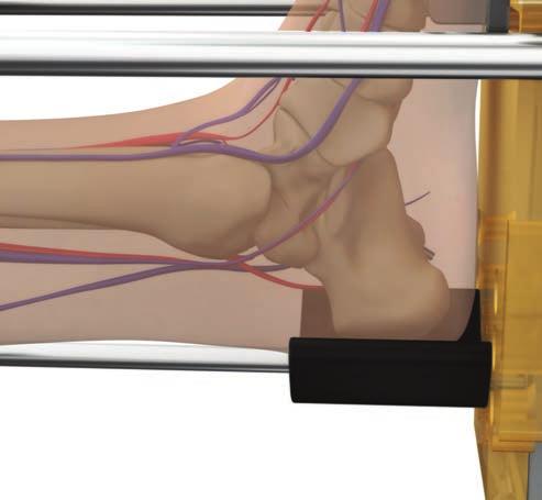 Spread the tissues at the medial incision site and insert a Drill Sleeve into the incision. Drill the Calcaneus Pin through the calcaneus using the Drill Sleeve (Fig. 29).