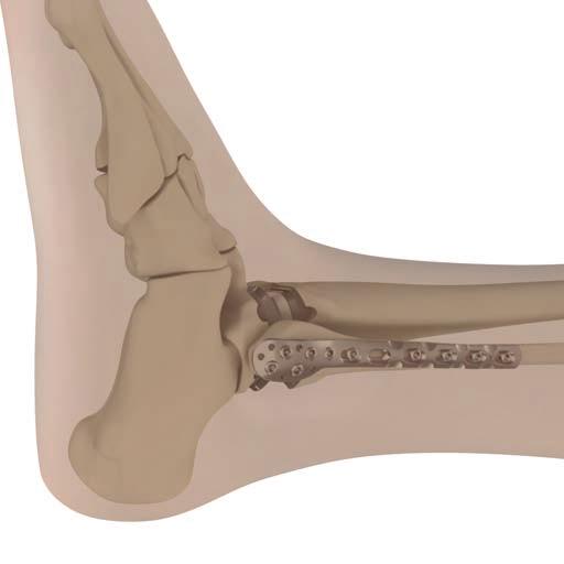 Section 11: Poly Revision Procedure SECTION 11 Section 11: Poly Revision Procedure Note: The procedure below describes poly revision while maintaining an intact fibula.