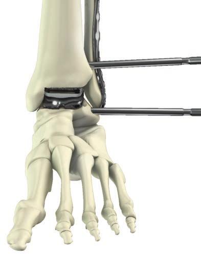 Note: Use of a distraction device is required for this procedure. Expose the ankle joint.