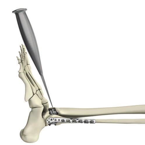 Apply a slight impaction force to the Osteotome. Be sure that the Osteotome is perpendicular to the anterior face of the tibial component.