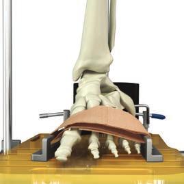 Tibial Crest Parallel 5-10 Place Straight Retractor into Medial Gutter Fig.