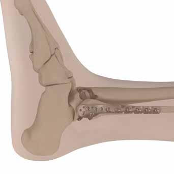 11 Section 11: Poly Revision Procedure Section 11: Poly Revision Procedure Note: The procedure below describes poly revision while maintaining an intact fibula.