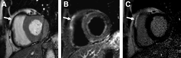 Subsequent coronary angiography revealed tight in-stent restenosis in the right coronary artery and significant flow-limiting disease in the left anterior descending coronary artery (C) as assessed