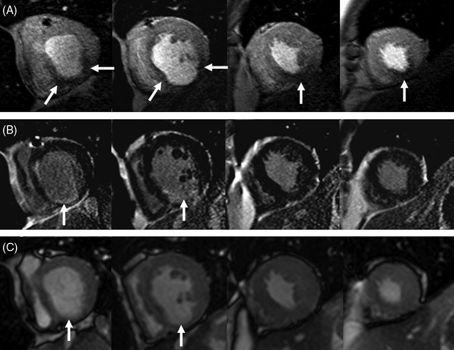 CMR images in the 4-chamber orientationfrom a patient with previous anteroseptal MI.