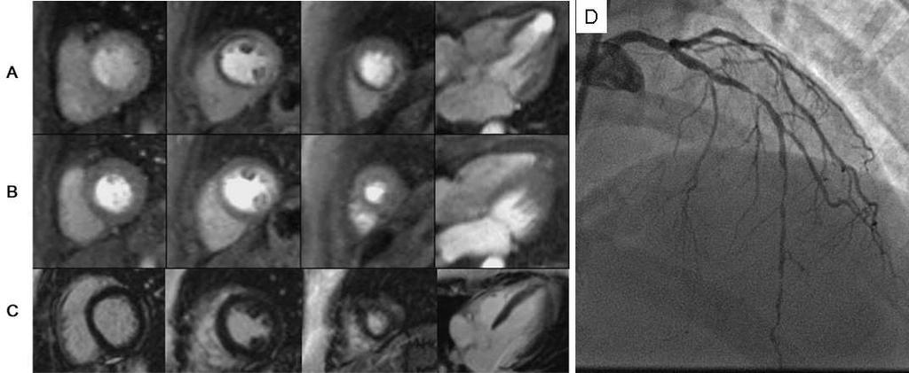 Ischemia no Infarct Myocardial perfusion CMR was performed in a 43 year-old female to evaluate exertional chest pressure.