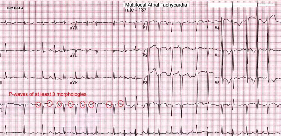 II- Pacemaker Abnormalities Supraventricular Tachycardia with