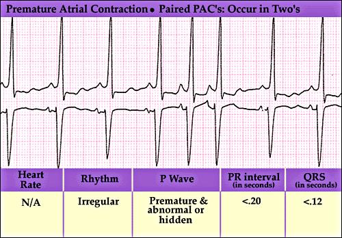 II- Pacemaker Abnormalities Supraventricular Tachycardia