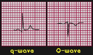 ECG Waves