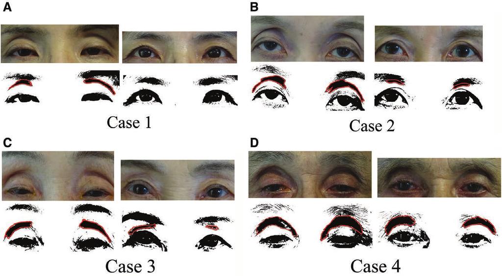 Mawatari et al. Changes in Sunken Eyes Fig. 1. A C, Correlation between age and preoperative values of MRD-1 (A), EBH (B), and AES (C).
